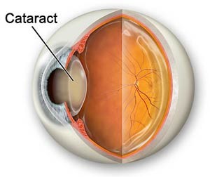 cataract-1
